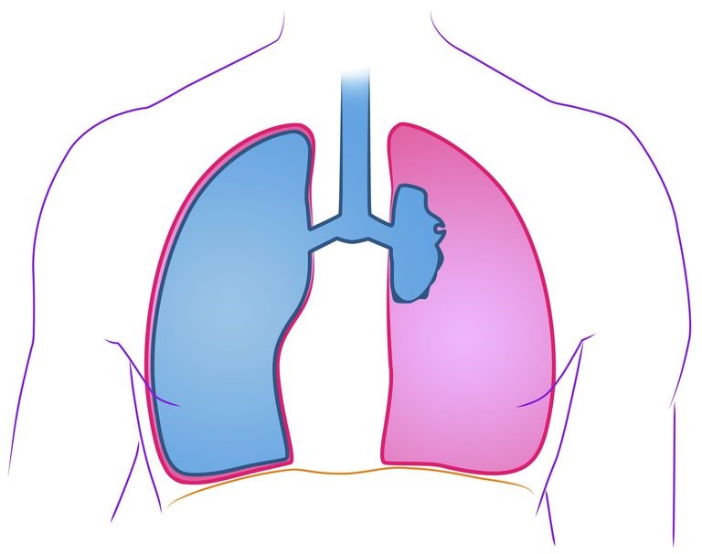 An illustration of a patient suffering from a collapsed lung.